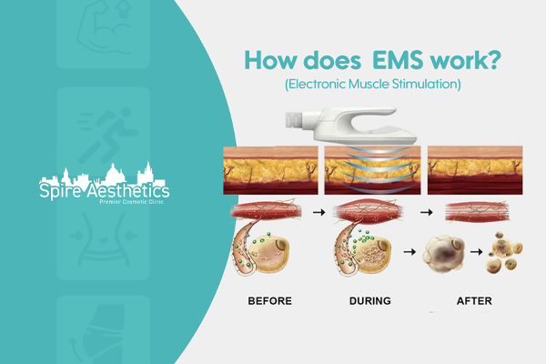 EMS treatment for post pregnancy weight loss treatment Hayes