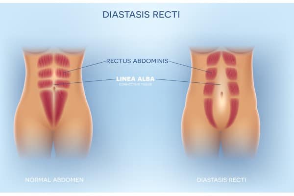 What Non-Surgical Options Are Available for Diastasis Recti Hayes?