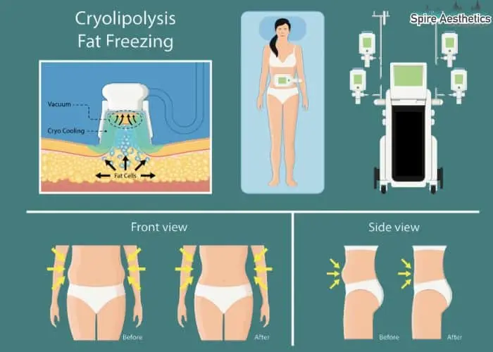 Fat freezing treatment Hayes benefits for competitions to remove stubborn fat deposits.