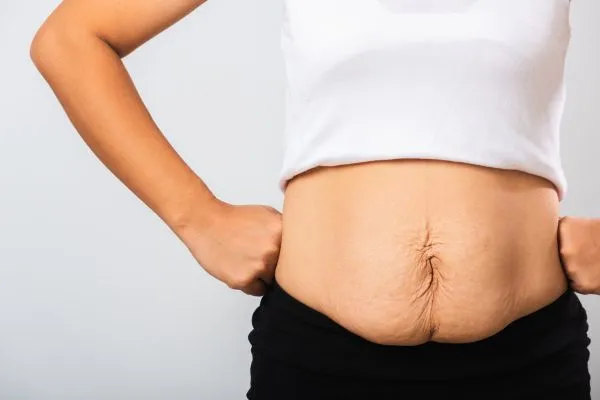 Image of a woman's stomach after weight loss with sagging skin following a gastric band Hayes