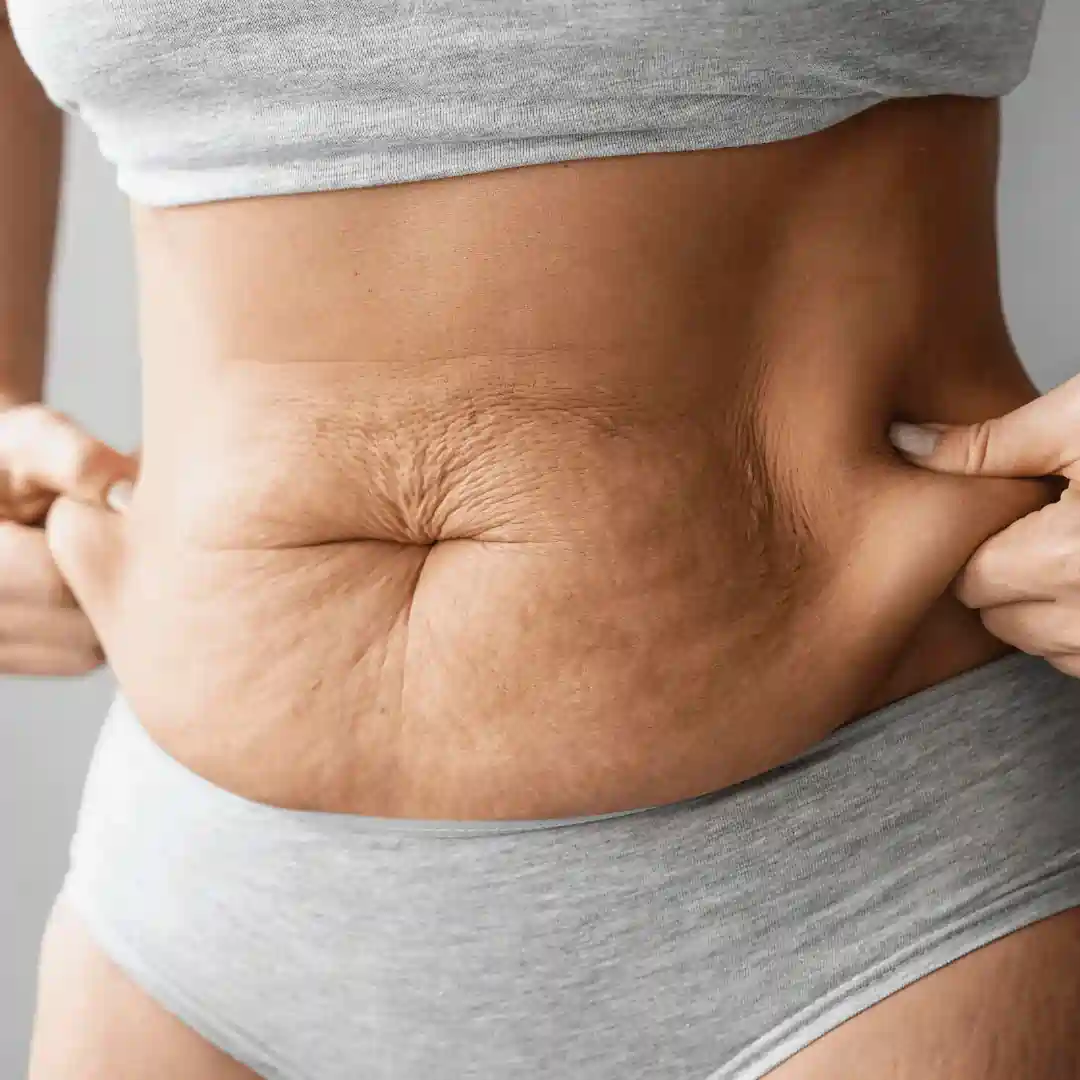 Is It Normal to Have Loose Skin After Pregnancy Hayes?