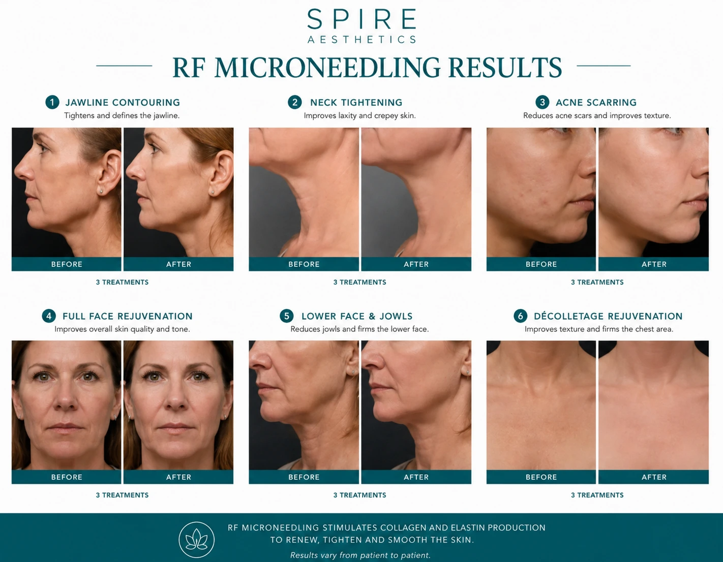 RF Microneedling Skin tightening Hayes results