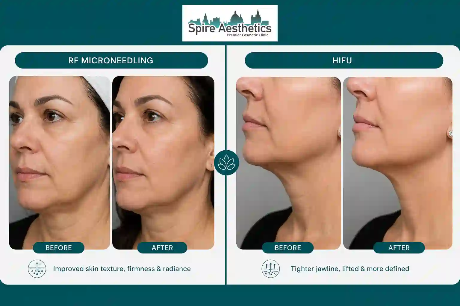 Can RF Microneedling and HIFU Be Combined Hayes?