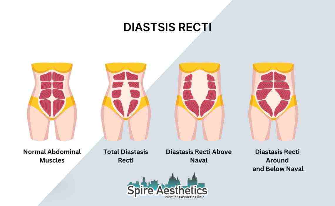 Is Non-Surgical Diastasis Recti Treatment Right for You? Common Concerns Answered Hayes